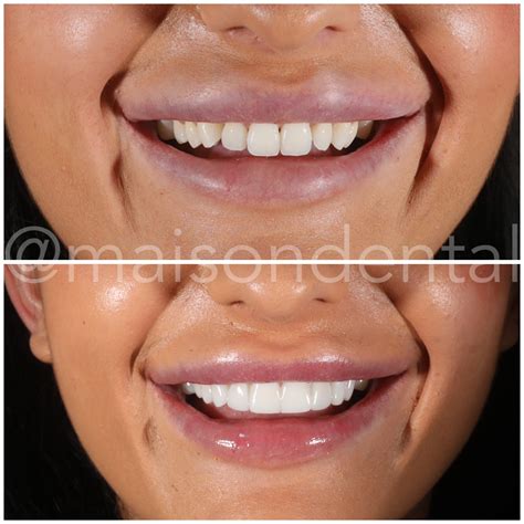 composite teeth veneers|direct composite veneers.
